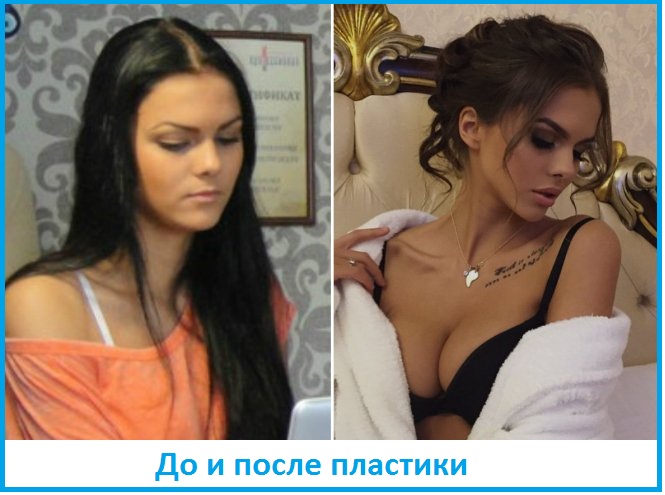 вика одинцова до и после пластики