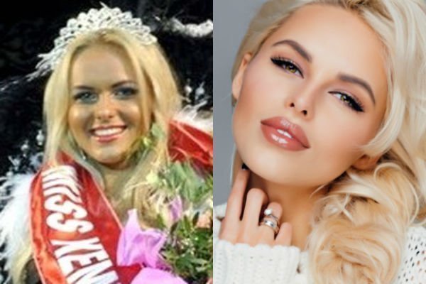 Ханна до и после пластики